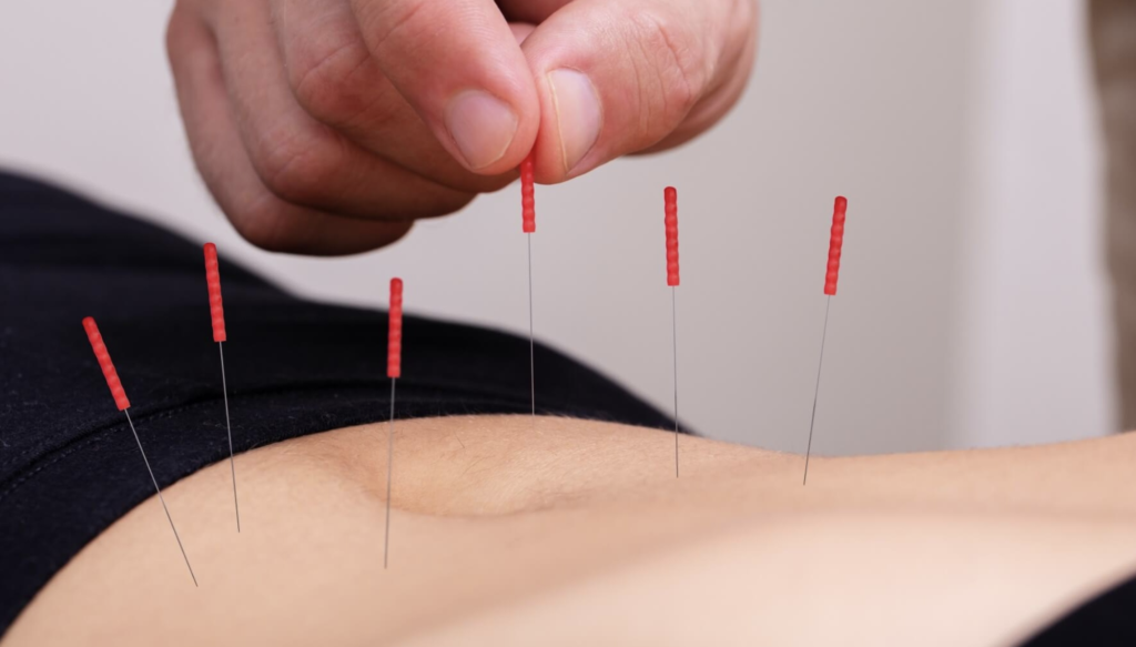 Korean acupuncture